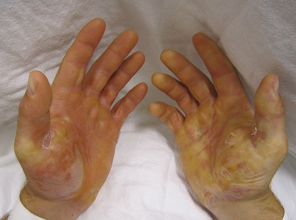 Skin like butterfly wings: UP scientists investigate rare deadly disease